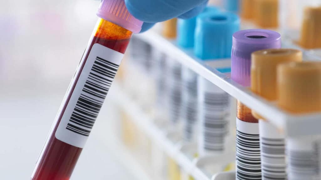 Anti Gliadin IgA Nedir?